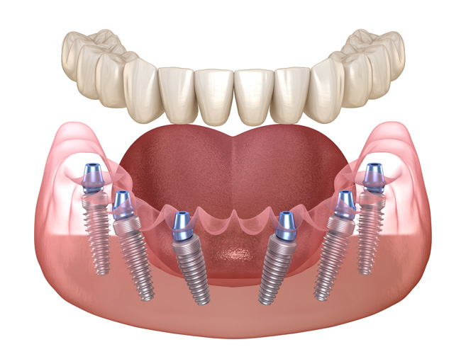 Illustration of All-on-6 Dental Implant