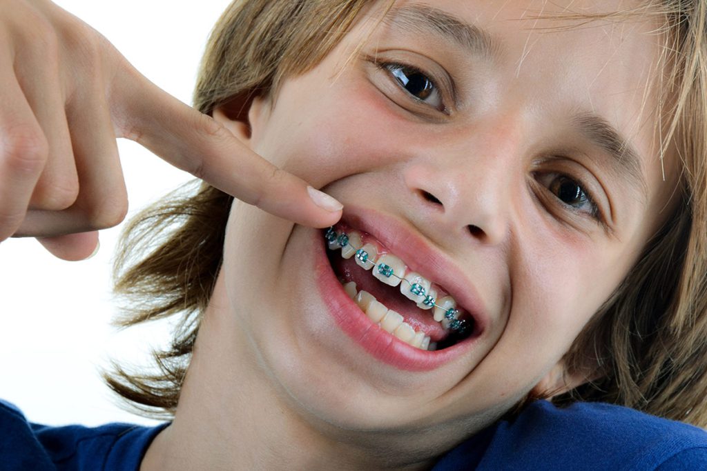 Braces Cost in Tijuana My Baja Dental Mexico