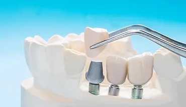 Dental Implant Image