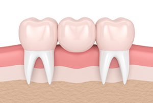 Dental Bridge