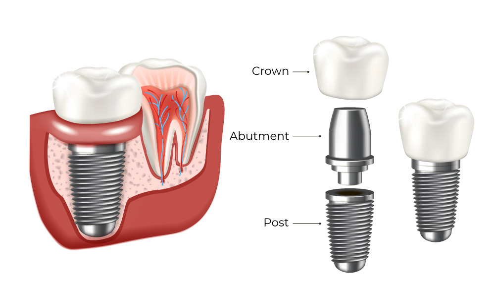 Medical infographic depicting components of implant - post, abutment, crown.