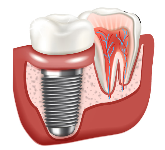 Illustration of single tooth implant
