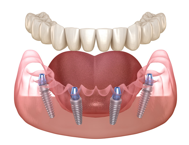 Illustration of All-on-4 Dental Implant