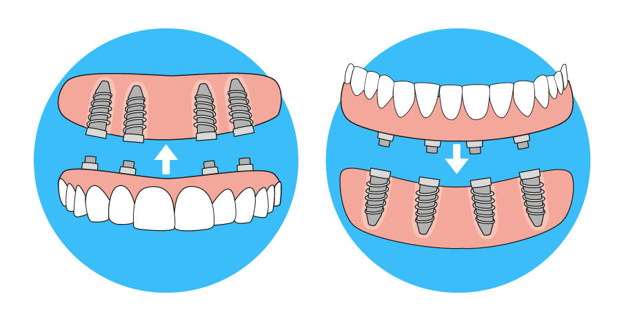 All on 4 dental implants