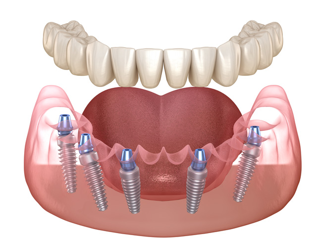 Illustration of All-on-5 Dental Implant