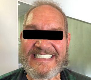 Patient after complete implant supported “All-on-6” fixed upper and lower