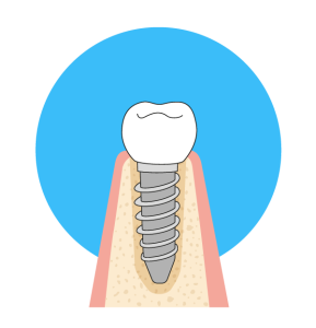 Single dental implant